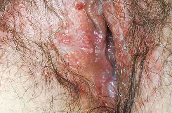 This closeup picture of a yeast infection is what I mean when I say that it