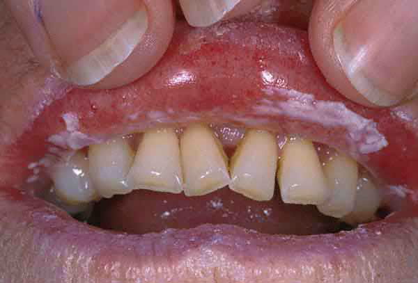 yeast infection photo yeast infection photo