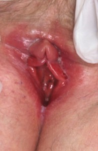 candida infection picture