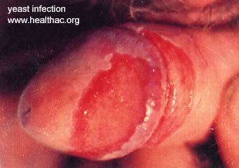 yeast infection of the penis photo yeast infection of the penis photo
